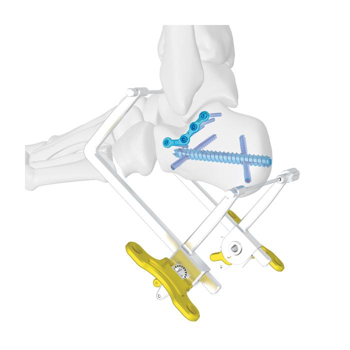 Calcaneal Cannulated Screw